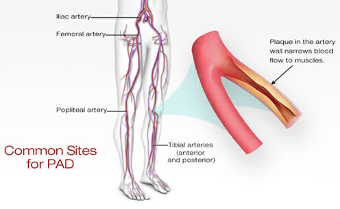 Diagram of the leg arteries showing the iliac, femoral, popliteal and tibial arteries, with a cut-away of an artery narrowed by plaque