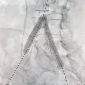 stent vbx gore iliac addressing aorta occlusive plays complex role covered important