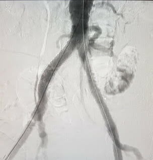 stent vbx iliac gore aorta addressing plays complex role covered important occlusive