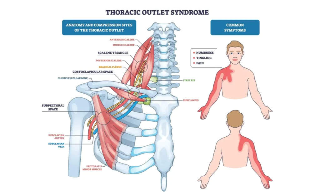 Thoracic outlet syndrome diagram shows compression of brachial plexus