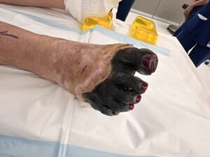 Dry gangrene of the toes in chronic limb-threatening ischaemia