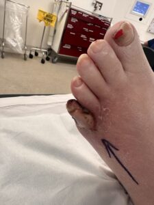 Ischaemic ulcer of the fifth toe