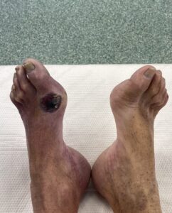 Ischaemic ulcer and dependent rubor of the foot compared with the other foot