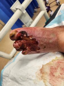 Extensive ischaemic ulceration of the forefoot with tissue loss