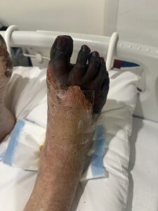 Dry gangrene of the toes and forefoot