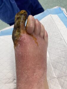 Gangrene of the great toe with ischaemic changes of the forefoot