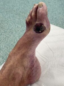 Punched-out arterial ulcer on the dorsum of the foot with dusky skin