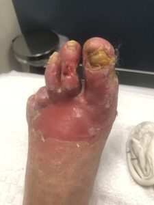 Ischaemic ulceration of the toes with dependent rubor of the forefoot