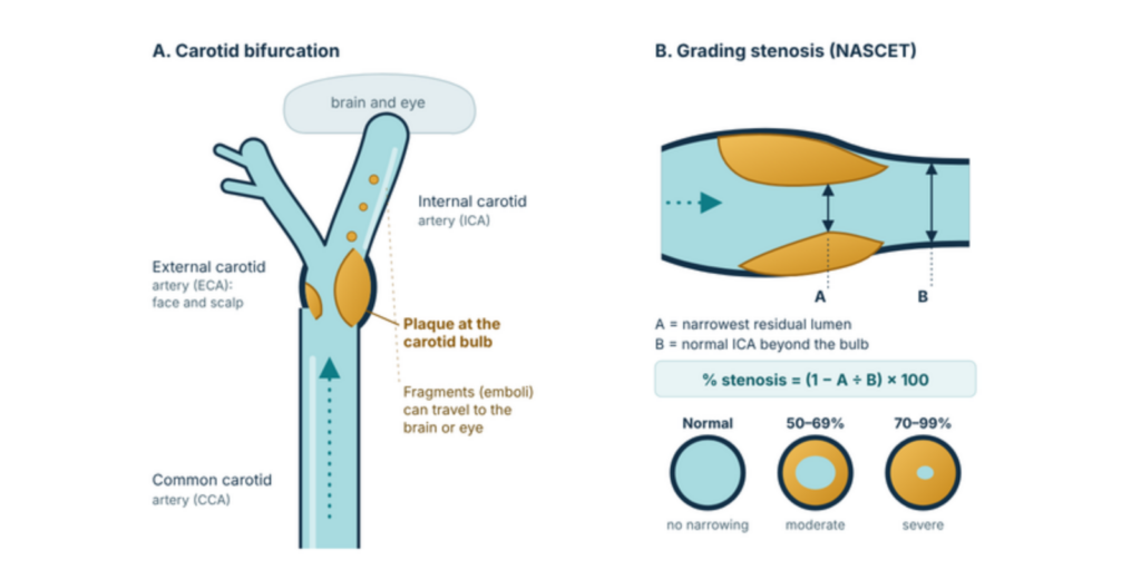 Diagram of plaque at the carotid bulb and how carotid stenosis is graded by the NASCET method