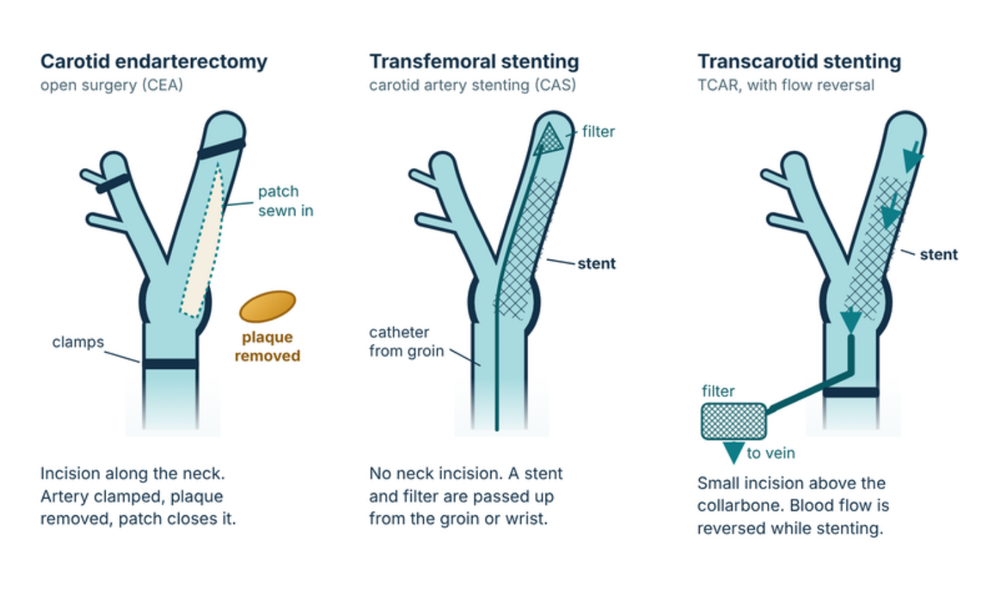 Diagram of the three carotid revascularisation options: carotid endarterectomy, transfemoral carotid stenting and transcarotid artery revascularisation (TCAR)