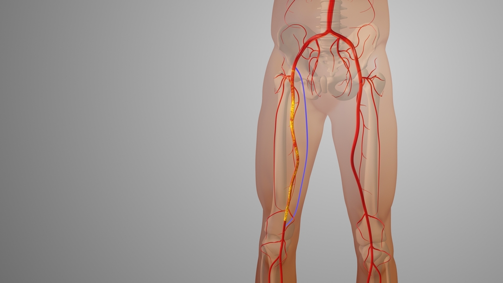 Peripheral arterial disease diagram