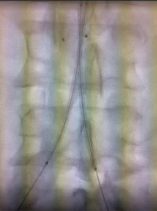 Gore Viabahn VBX covered stent used in complex aorto-iliac reconstruction