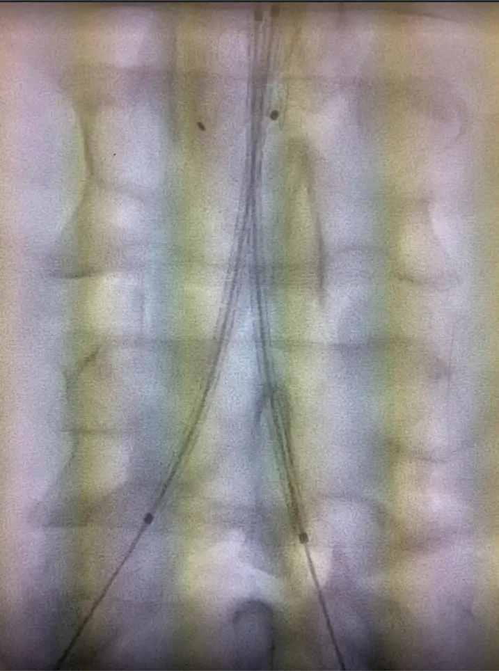 Gore Viabahn VBX covered stent used in complex aorto-iliac reconstruction