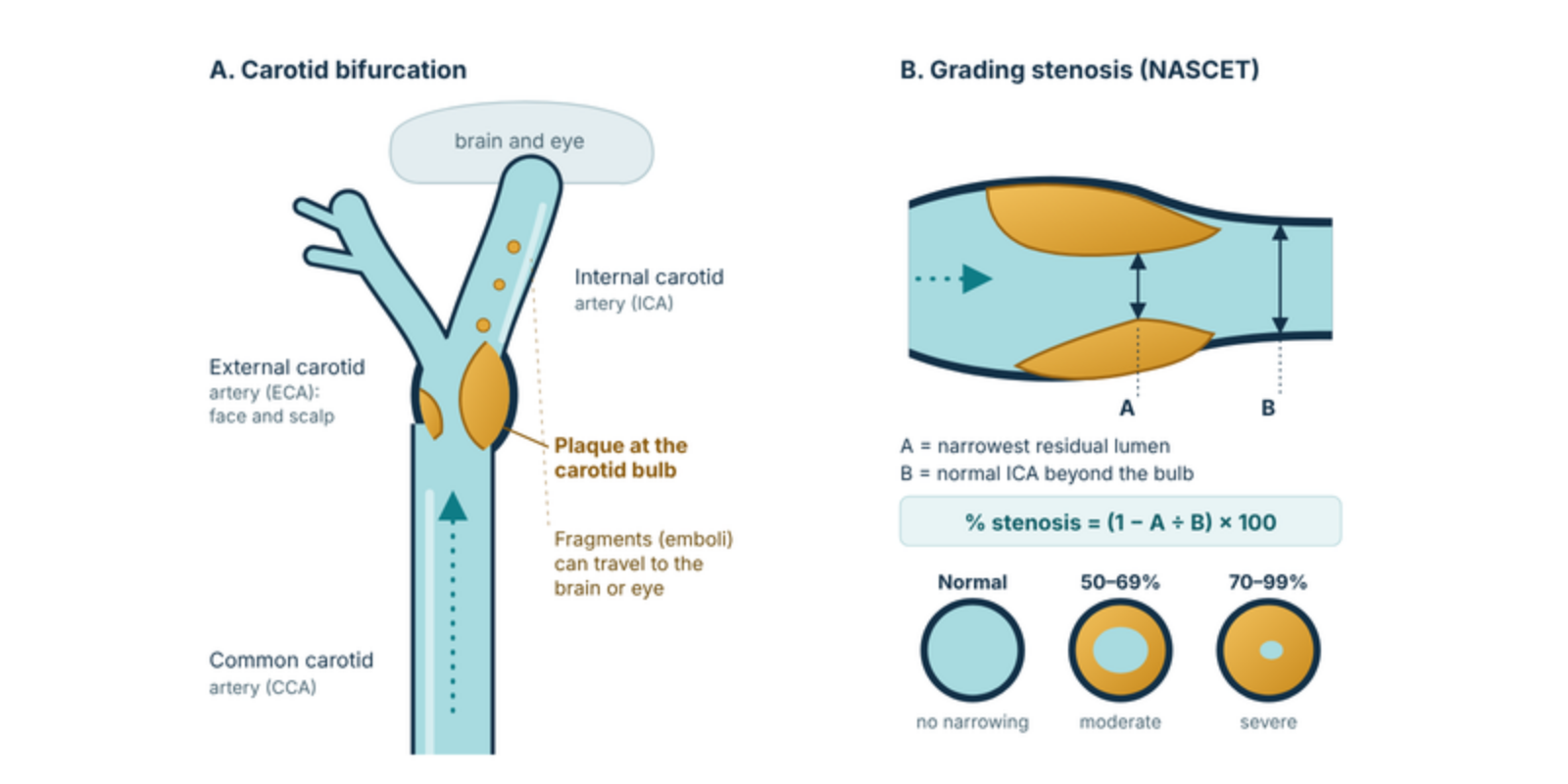 Diagram of plaque at the carotid bulb and how carotid stenosis is graded by the NASCET method