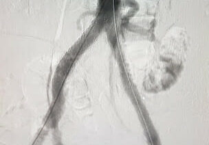 Gore Viabahn VBX Covered Stent plays important role in addressing complex aorta-iliac occlusive3