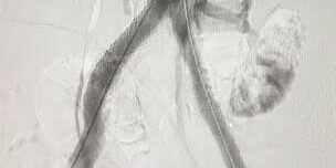 Gore Viabahn VBX Covered Stent plays important role in addressing complex aorta-iliac occlusive3