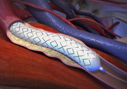 Is Gore VBX a better alternative for CERAB reconstructions2