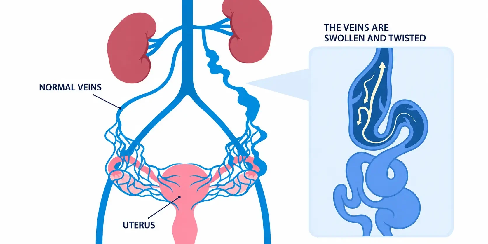 Ovarian vein reflux normal pelvic veins