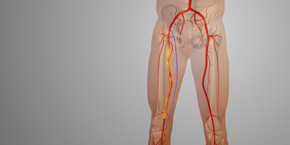 Peripheral arterial disease diagram