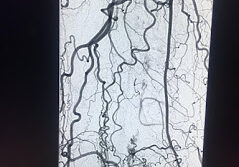 Popliteal Artery chronic total occlusion in the patient with CLI