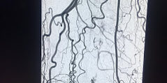 Popliteal Artery chronic total occlusion in the patient with CLI