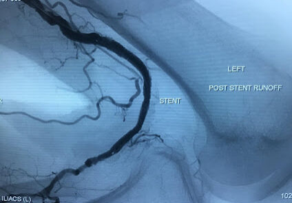 Popliteal Artery occlusion treated with Gore Tigris self-expanding stent3