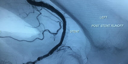 Popliteal Artery occlusion treated with Gore Tigris self-expanding stent3