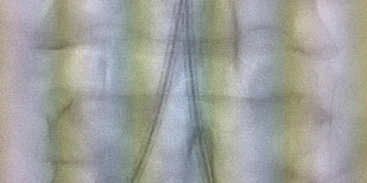 Gore Viabahn VBX covered stent used in complex aorto-iliac reconstruction