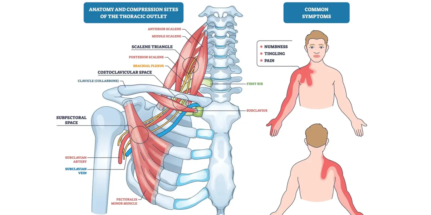 Thoracic outlet syndrome diagram shows compression of brachial plexus